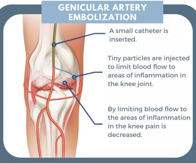 Genicular Artery Embolization