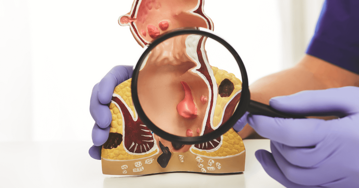 Hemorrhoid Artery Embolization