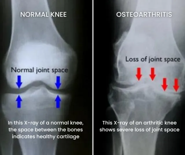 Normal Knee Vs Osteoarthritis