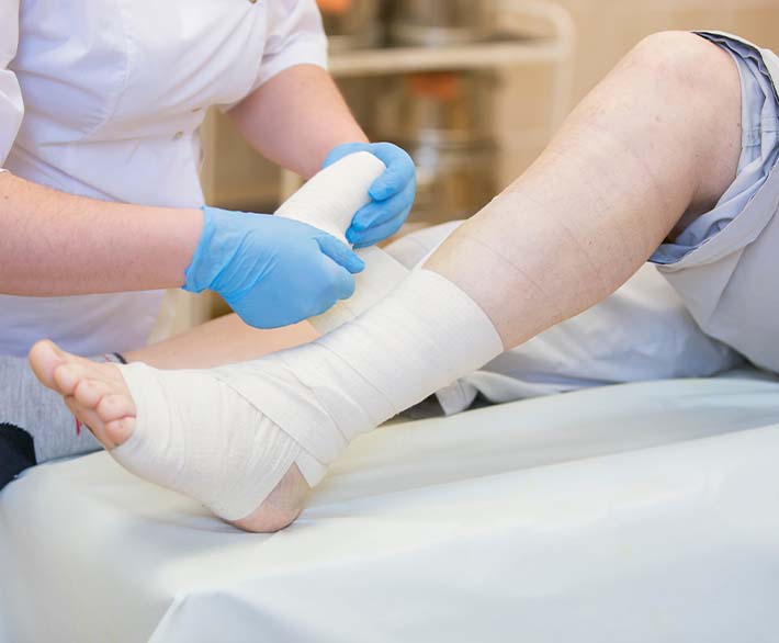Plantar Fasciitis Embolization (PFE) 3 Benefits of Embolization Treatments at Indy Vascular